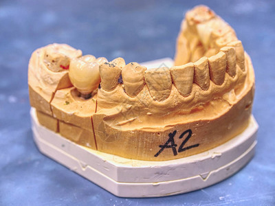 全口种植牙牙科实验室石膏模型上的人牙陶瓷和锆冠牙冠修复的背景