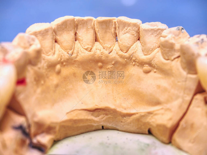 在石膏模型上试用金属陶瓷牙冠牙科护理概念带假牙的人类牙齿图片