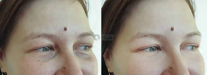 治疗前后的女人皱纹脸色素沉着图片
