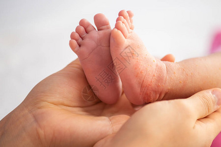 婴儿腿皮肤红干图片