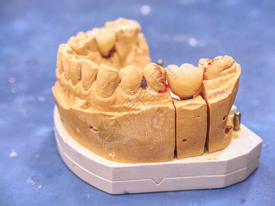 在牙科假牙实验室用固定假牙的JawJawJus图片