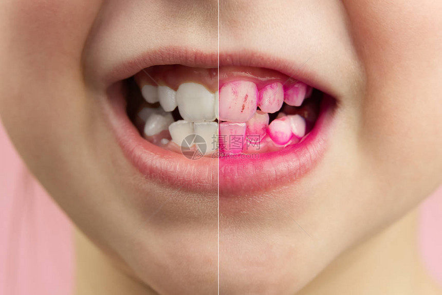 工作中显示片剂的前后效果关闭了年轻男孩牙齿的照片图片