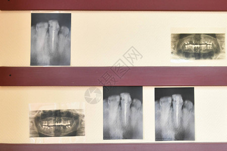 牙齿的X光片问题牙齿牙齿有问题图片