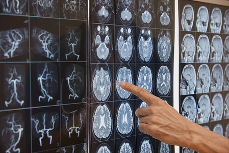 在手术室灯盒上的脑磁共振成像胶片上指着一个医图片