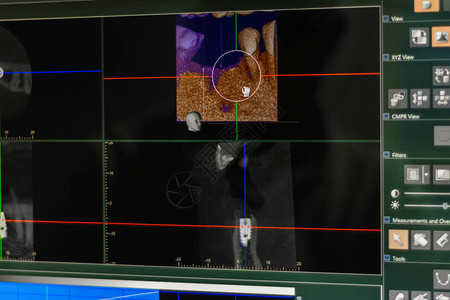 牙医在个人电脑屏幕上分析颌骨的X光照图片