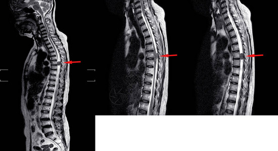背部疼痛向臀部和双腿辐射图片