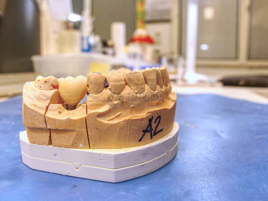 半加工中的假牙人造牙修复体手工制作的现代牙科陶瓷植入物的测试图片