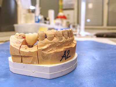 牙面假体石膏高清图片