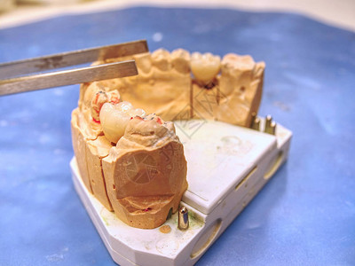 假肢实验室的牙科铸造石膏模型下巴牙科矫形术图片