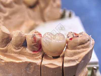 带针和牙科植入物的牙科植入物模型人类颌骨的牙科铸造石膏模型弯曲的牙图片