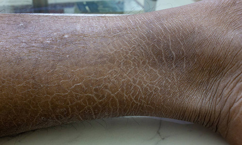 皮肤干燥的腿背景图像图片
