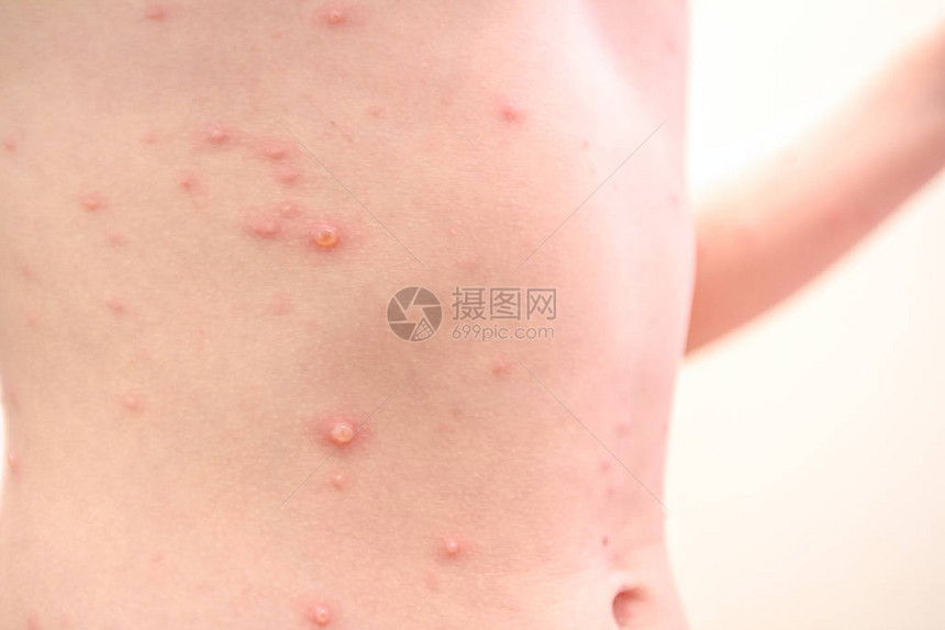 患有虫的儿童有麻疹天花风疹等疾病图片