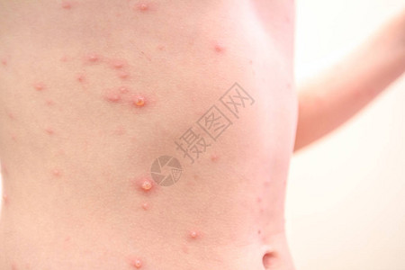 患有虫的儿童有麻疹天花风疹等疾病背景图片