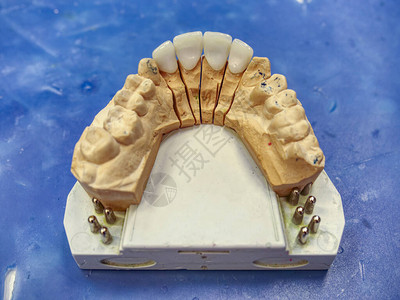 在口腔中放置固定部分假牙的科或牙科技术图片