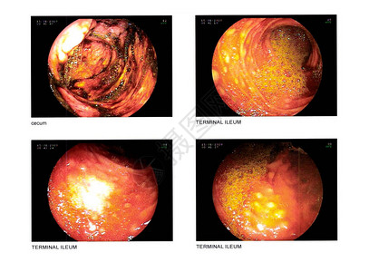 Colonoscopic图像图片