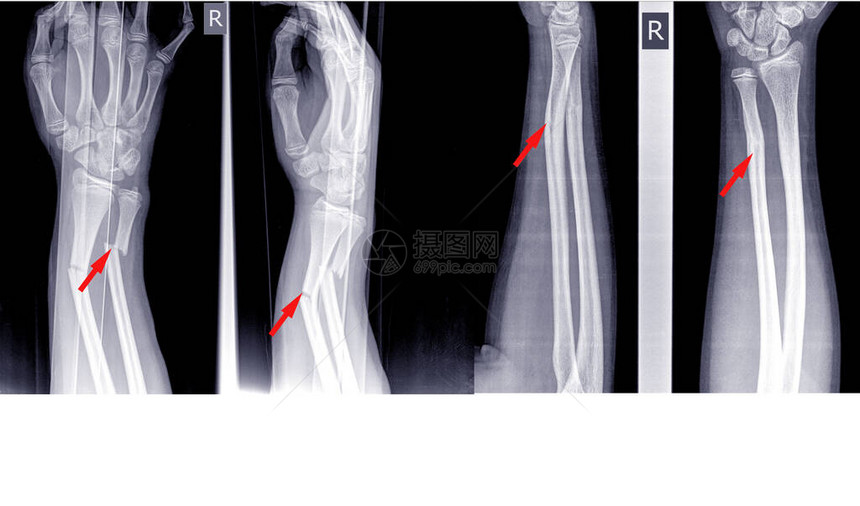 手腕关节右侧X射线图像图片