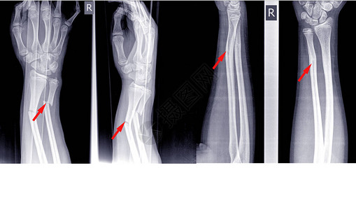 手腕关节右侧X射线图像高清图片