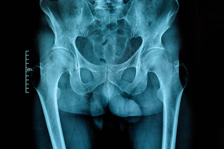 对成年男患有骨髓炎的臀关节进行X光检查图片