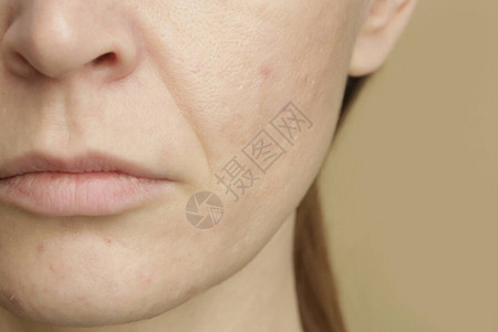 鼻唇沟近身女面临问题敏感的皮肤有大孔背景