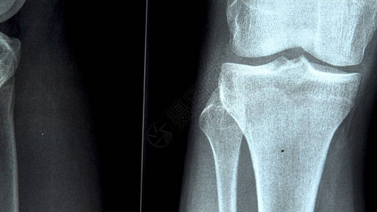 膝关节的X光片合拍X光图像从下背景图片