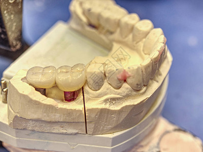 假肢实验室的牙科铸造石膏模型人爪牙医学和矫形学图片