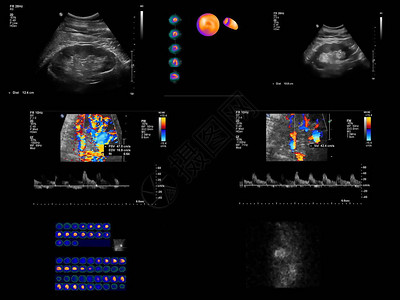 卵巢囊肿冠状计算断层摄影血管学CCTA使用注射含碘的对比度材料和CT扫描来检查向心脏提供血液的动脉背景