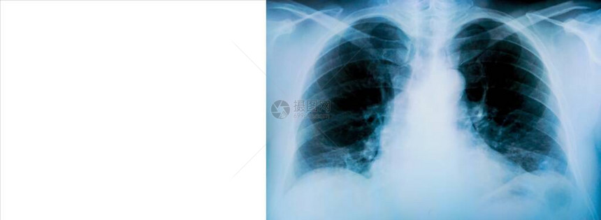 对病人的肺部进行X光检查图片