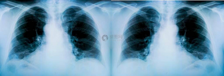 对病人肺部进行一系列X光检查并有明显发图片