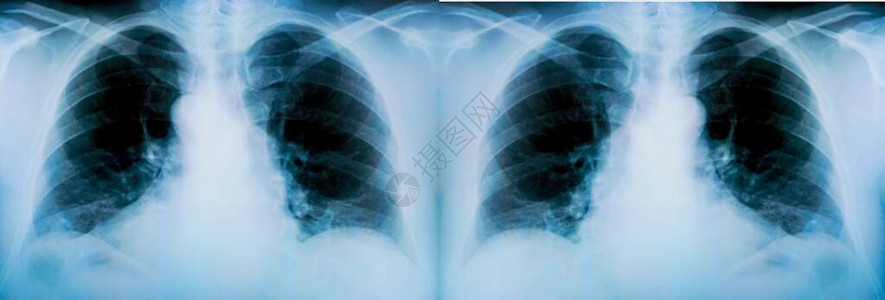 对病人肺部进行一系列X光检查并有明显发背景图片