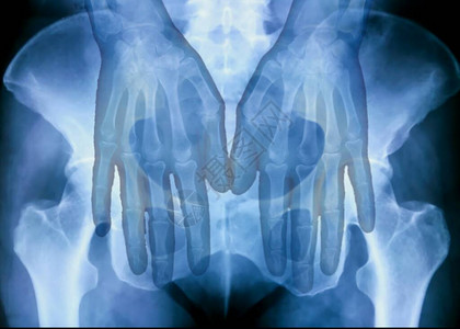 人手和骨盆骼的X光板S图片