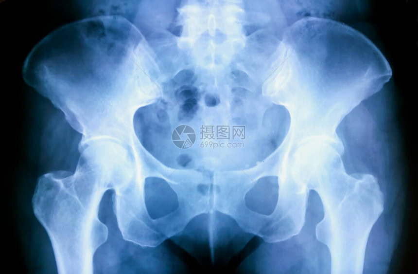 X光骨盆图片