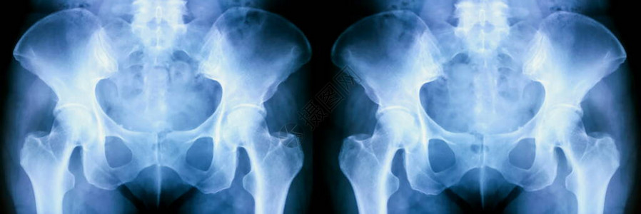 一组人骨盆X射线图片