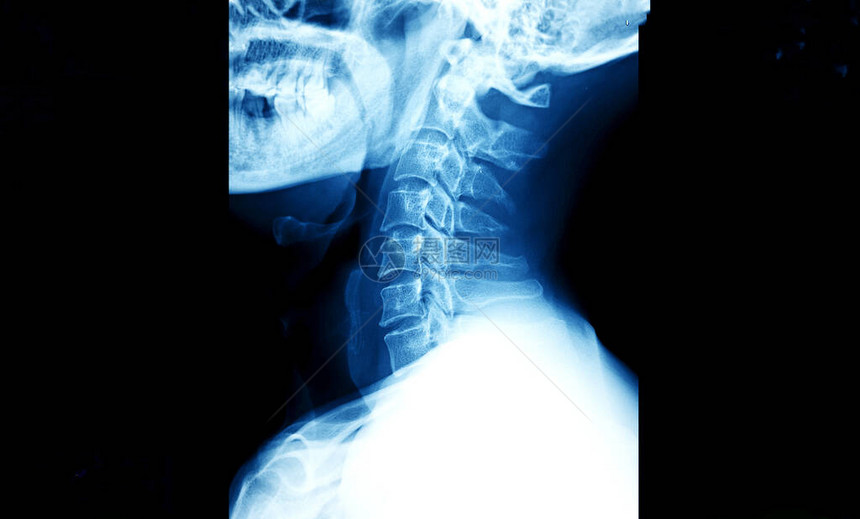 颈部X光片许多图片