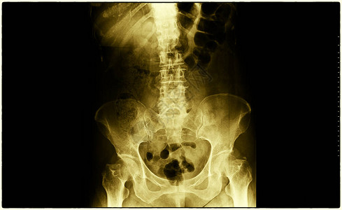脊椎和骨盆X光许多图片