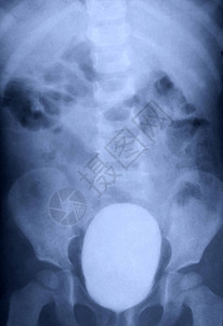 儿童全膀胱X线对比研究医学膀胱造影诊断测试射线MRIC图片