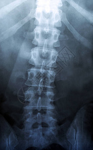 射线骨干人体骨骼医学脊柱侧弯或骨软病诊断测试X射线MRIC图片