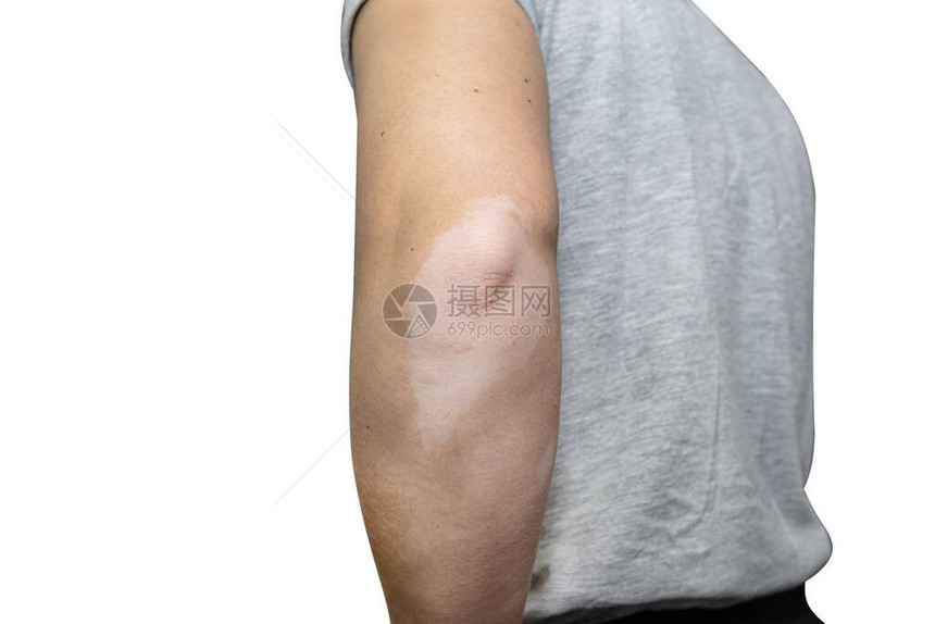 一位年轻的高加索女手肘上有来自维蒂里戈病的针刺图片