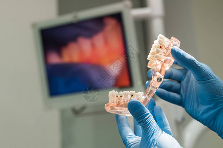 牙科医生用植入的牙齿握图片