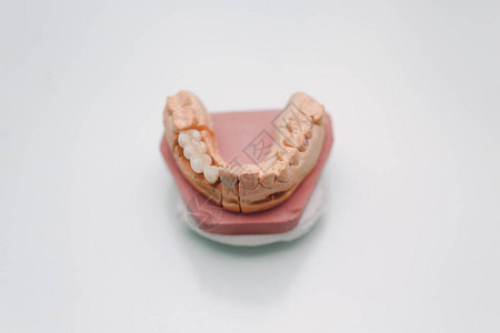 带有牙齿和植入物的人类颌骨的牙齿布局图片