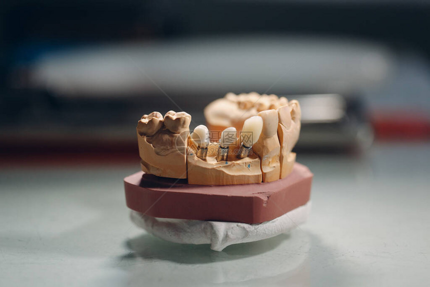 带有牙齿和植入物的人类颌骨的牙齿布局图片