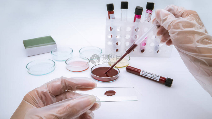 在实验室中用移液管添加冠状感染的血液样本进行生化测试医学测试在实验室对电晕进行分析的科学图片
