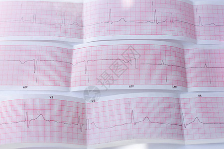 年轻人的心电图图片
