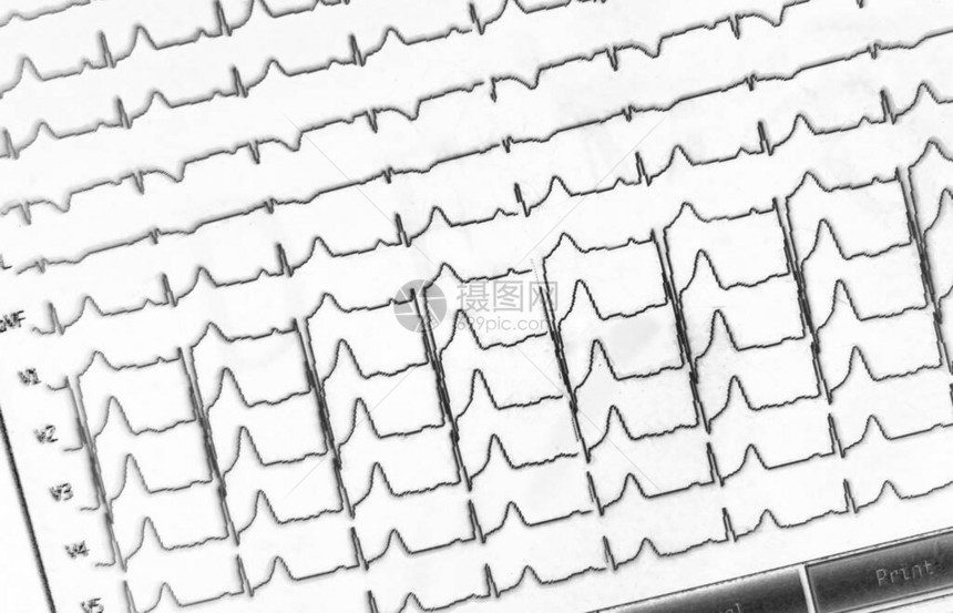 医院患者心电图波形显示图片