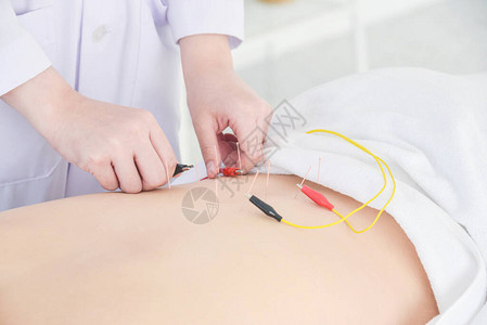 在病人背部用电动模拟器做针刺手术的针刺手图片