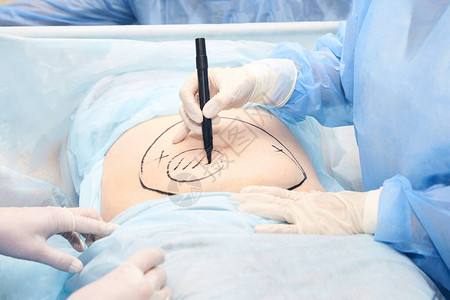 手术室腹部手术医生在腹部标记吸脂区域在皮肤上绘图抗脂肪团设备复制空间浅蓝色腹部肥胖Hostip图片