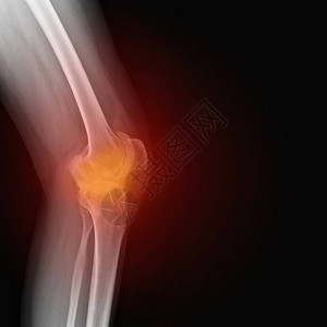 患有风湿病的女膝盖真正的骨骼X光片类风湿关节炎膝痛医学概念医学诊断图片