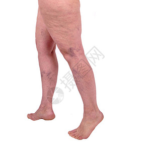 女腿有静脉曲张和腿蜘蛛人类健康和疾病的概念白色背景血管疾病图片