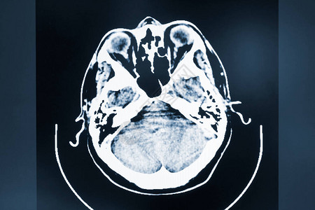病人脑电磁扫描仪健康和医学图片