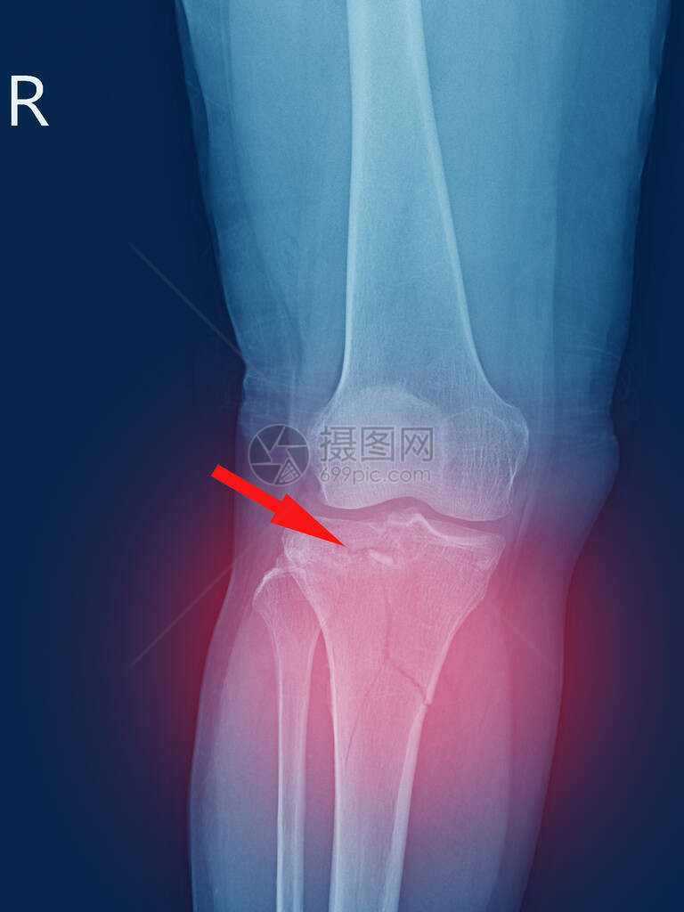 线膝关节胫骨近端干骺端骨折胫骨外侧平台凹陷骨折红点软组织严重肿胀图片