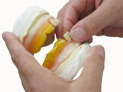 塑造石膏假牙的专业手图片